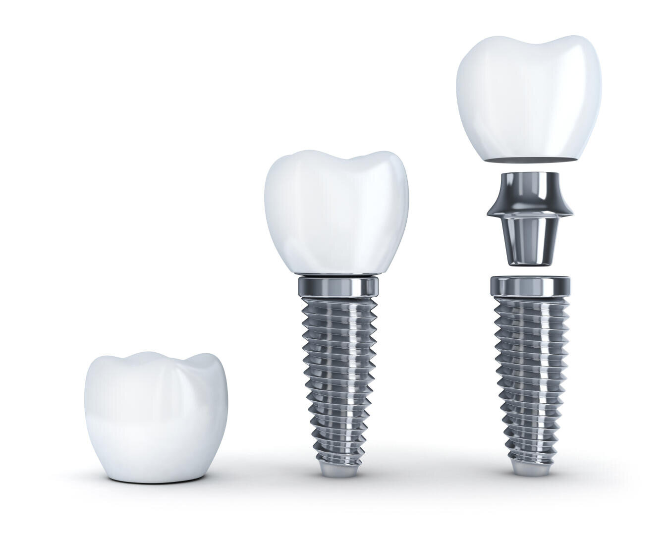Drei Zahnimplantate, die die einzelnen Phasen des Zusammenbaus zeigen: eine Zahnkrone allein, eine an einer Metallschraube befestigte Krone und eine getrennte Ansicht mit den Komponenten Krone, Abutment und Schraube auf weißem Hintergrund.