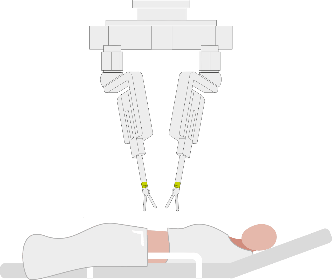 Abbildung eines Patienten, der auf einem Operationstisch liegt, über dem sich ein robotergestütztes Operationssystem befindet. Zwei mechanische Arme sind über dem Bauch des Patienten positioniert, was auf eine robotergestützte Operation schließen lässt.