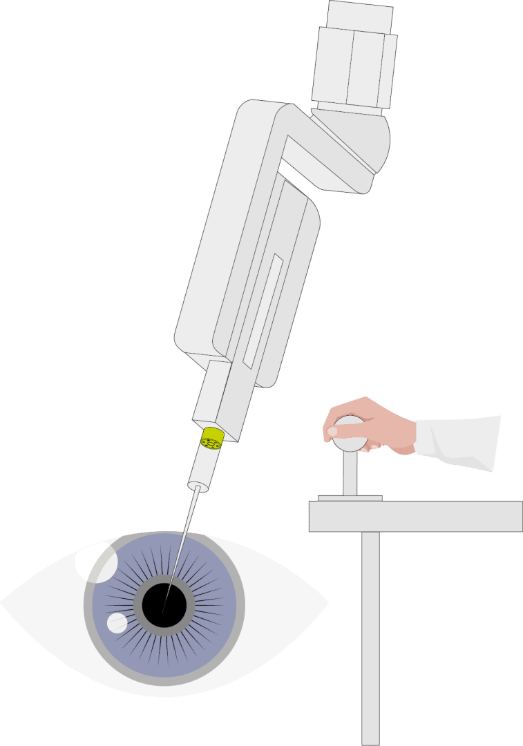 Abbildung: Ein Roboterarm sticht eine Nadel in ein Auge, während eine Hand die Robotersteuerung von einer nahegelegenen Konsole aus bedient.