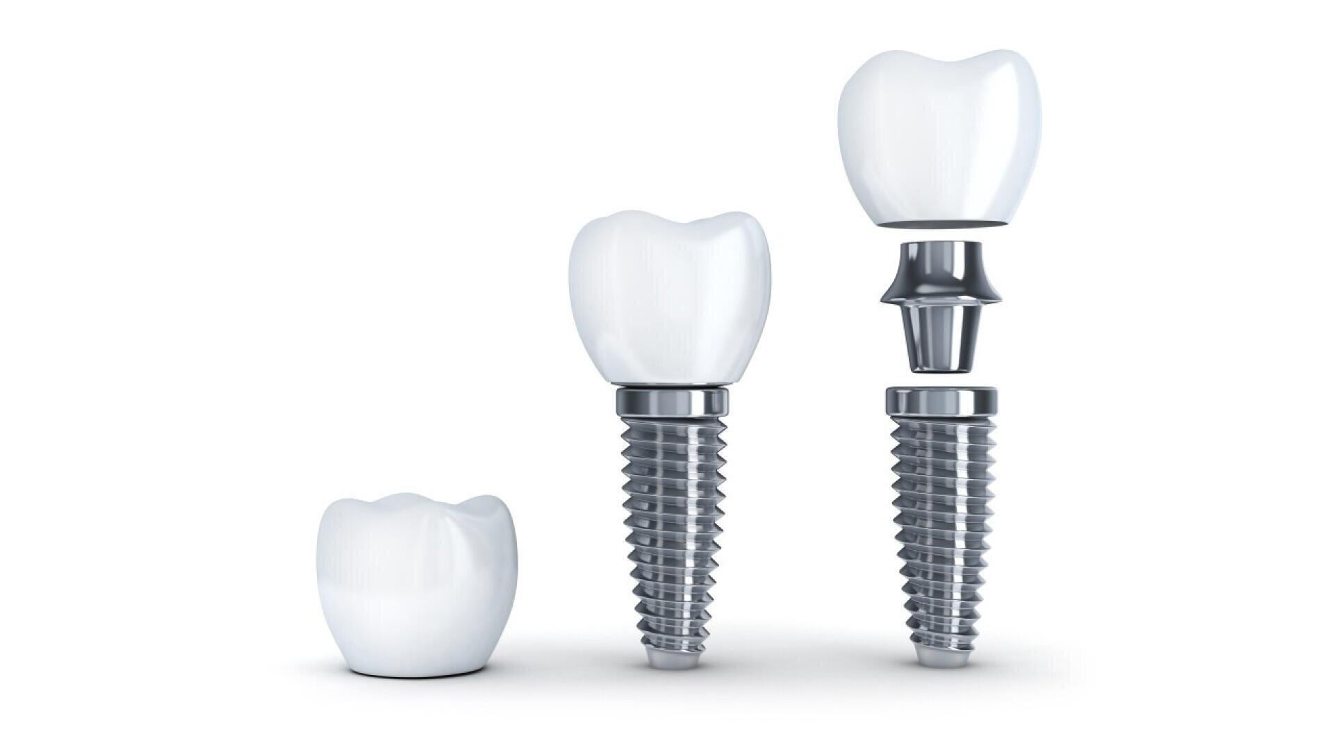 Three dental implants are shown in stages: a single white crown, a crown attached to a metal screw, and a fully assembled implant with a post and crown, all on a white background.